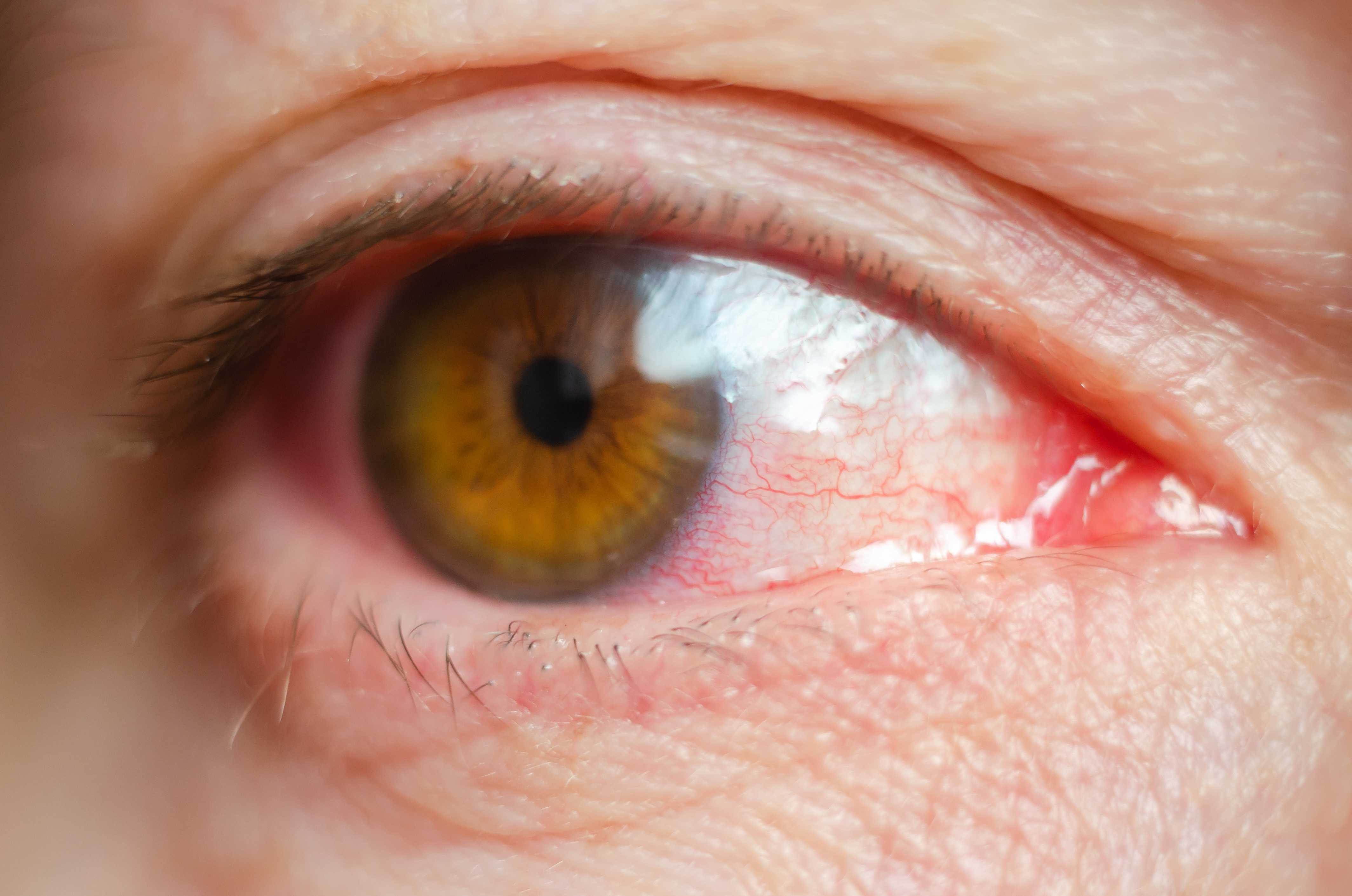 Uvea And Ocular Inflammation Treatment In Allahabad Best Uvea And